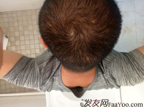 這世界還很美！感謝南寧大麥微針植發(fā)2860單位