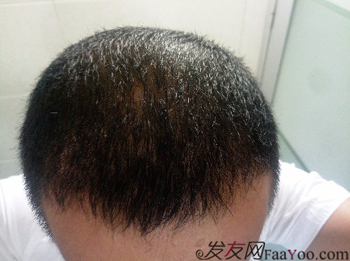 這世界還很美！感謝南寧大麥微針植發(fā)2860單位