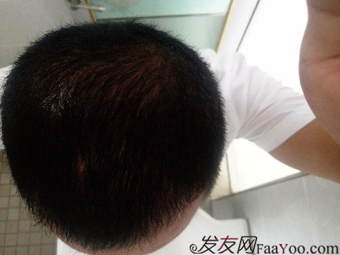 這世界還很美！感謝南寧大麥微針植發(fā)2860單位