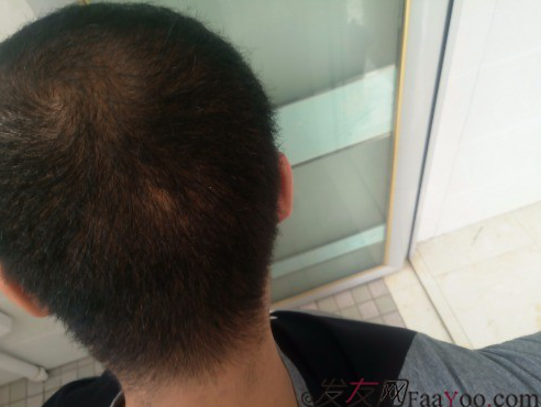 這世界還很美！感謝南寧大麥微針植發(fā)2860單位