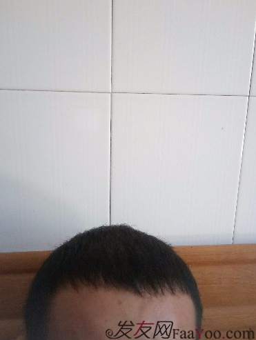 這世界還很美！感謝南寧大麥微針植發(fā)2860單位