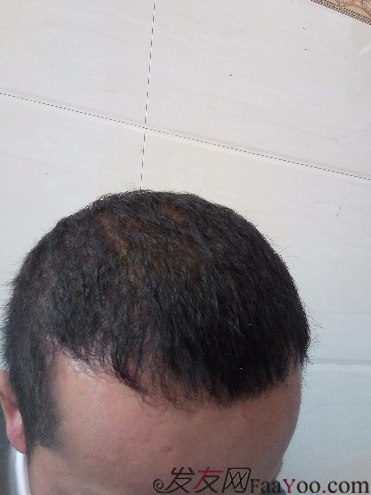 這世界還很美！感謝南寧大麥微針植發(fā)2860單位