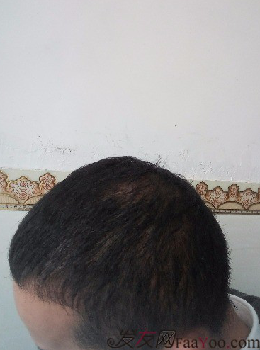 這世界還很美！感謝南寧大麥微針植發(fā)2860單位