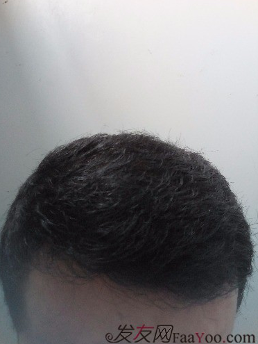 這世界還很美！感謝南寧大麥微針植發(fā)2860單位