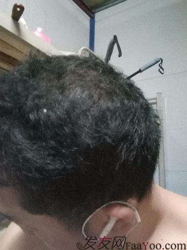 這世界還很美！感謝南寧大麥微針植發(fā)2860單位