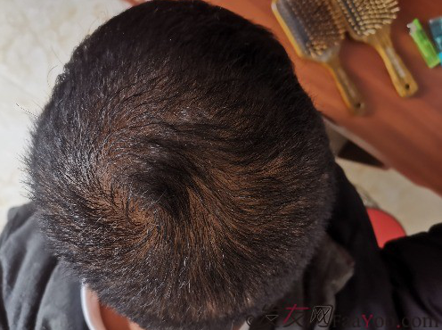 這世界還很美！感謝南寧大麥微針植發(fā)2860單位