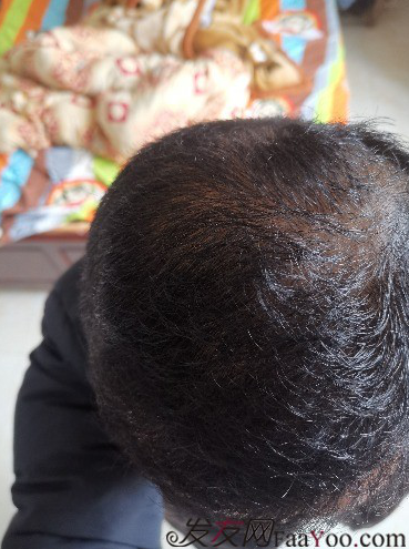 這世界還很美！感謝南寧大麥微針植發(fā)2860單位