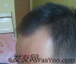 西安大麥微針植發(fā)案例，繼續(xù)看我逆襲蛻變