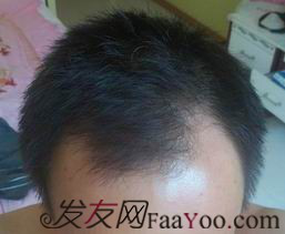 西安大麥微針植發(fā)案例，繼續(xù)看我逆襲蛻變