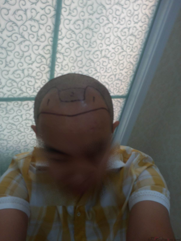 西安大麥微針植發(fā)案例，繼續(xù)看我逆襲蛻變