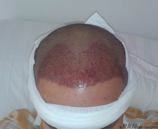 西安大麥微針植發(fā)案例，繼續(xù)看我逆襲蛻變