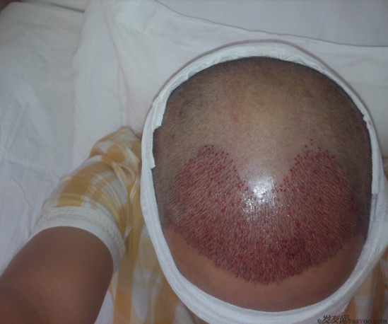 西安大麥微針植發(fā)案例，繼續(xù)看我逆襲蛻變