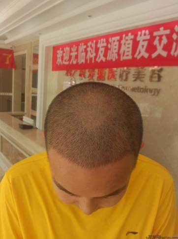 西安大麥微針植發(fā)案例，繼續(xù)看我逆襲蛻變