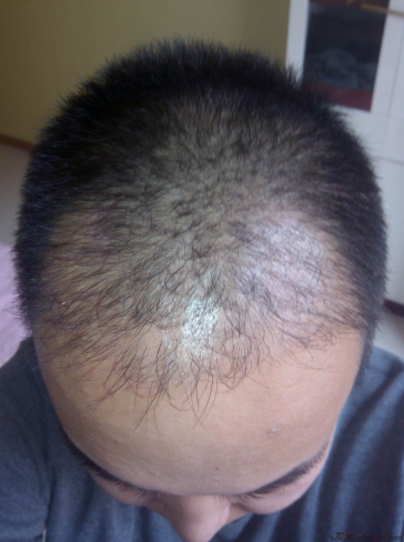 西安大麥微針植發(fā)案例，繼續(xù)看我逆襲蛻變