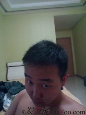 西安大麥微針植發(fā)案例，繼續(xù)看我逆襲蛻變