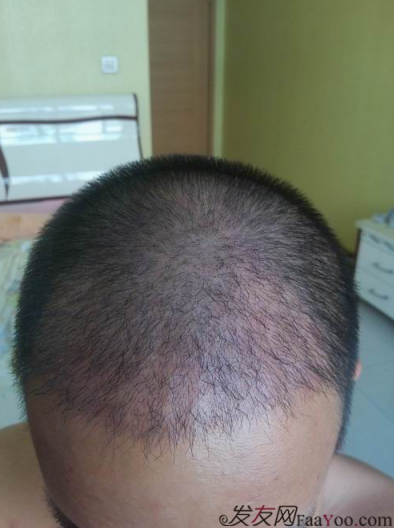 西安大麥微針植發(fā)案例，繼續(xù)看我逆襲蛻變