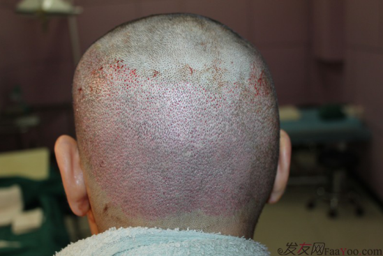 北京植發(fā)2700單位，我一步步的拾回了自信