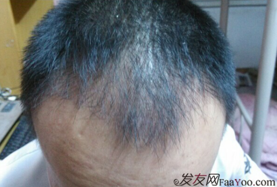 北京植發(fā)2700單位，我一步步的拾回了自信