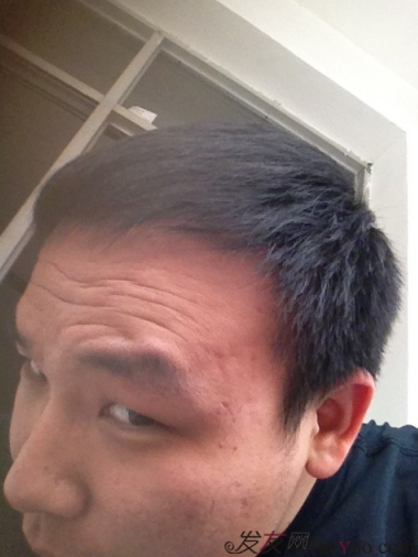 北京植發(fā)2700單位，我一步步的拾回了自信