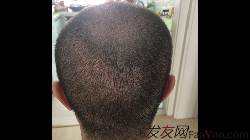 沈陽牛大夫植發(fā)好醫(yī)生優(yōu)惠活動,3900單位看最后效果