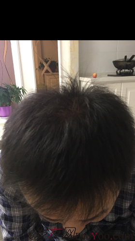 沈陽牛大夫植發(fā)好醫(yī)生優(yōu)惠活動,3900單位看最后效果