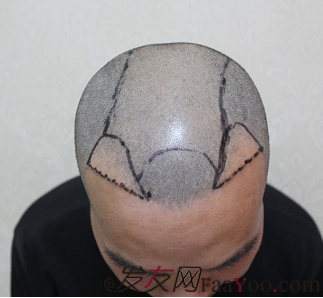 植發(fā)日記南昌廣濟(jì)植發(fā)，慢慢看我改變從此恢復(fù)自信