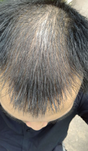 植發(fā)日記南昌廣濟(jì)植發(fā)，慢慢看我改變從此恢復(fù)自信