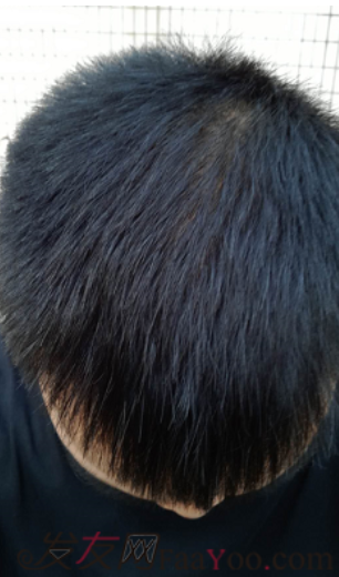 植發(fā)日記南昌廣濟(jì)植發(fā)，慢慢看我改變從此恢復(fù)自信