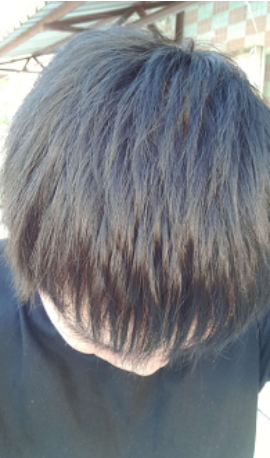 植發(fā)日記南昌廣濟(jì)植發(fā)，慢慢看我改變從此恢復(fù)自信