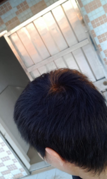 植發(fā)日記南昌廣濟(jì)植發(fā)，慢慢看我改變從此恢復(fù)自信