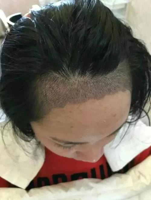 碧蓮盛植發(fā)