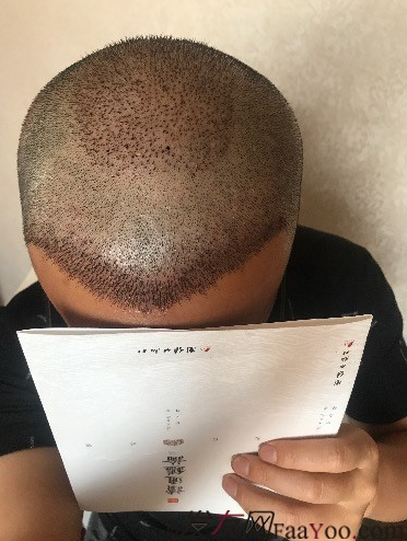 相約重慶植發(fā)，等待枯木逢春，意氣風(fēng)發(fā)之時。