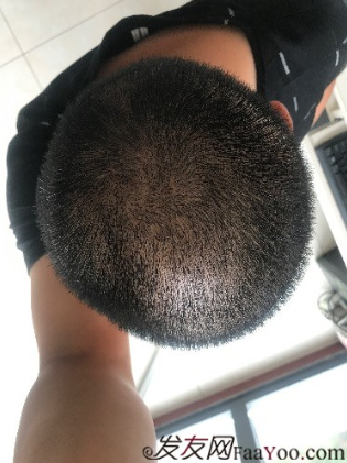 相約重慶植發(fā)，等待枯木逢春，意氣風(fēng)發(fā)之時。