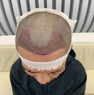 發(fā)友網(wǎng)與機(jī)構(gòu)活動(dòng)植發(fā)，前后效果對比、記錄