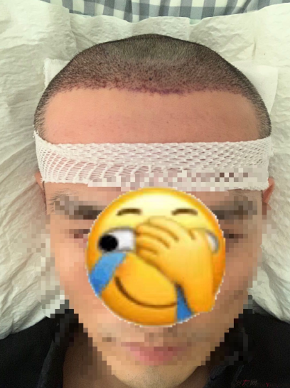 發(fā)友網(wǎng)與機(jī)構(gòu)活動(dòng)植發(fā)，前后效果對比、記錄