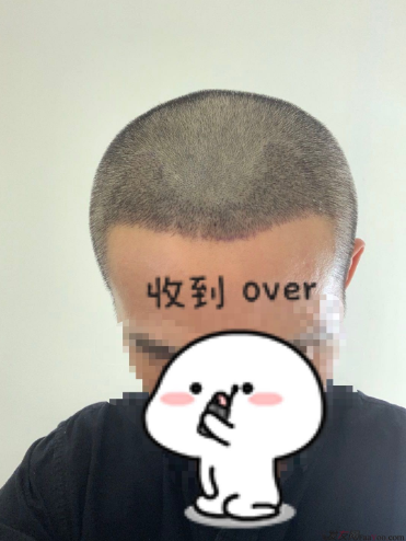 發(fā)友網(wǎng)與機(jī)構(gòu)活動(dòng)植發(fā)，前后效果對比、記錄