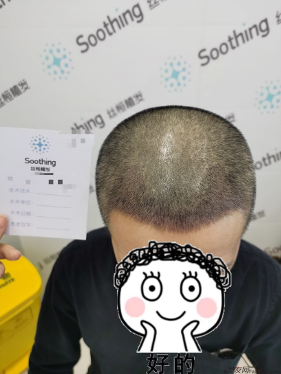 發(fā)友網(wǎng)與機(jī)構(gòu)活動(dòng)植發(fā)，前后效果對比、記錄