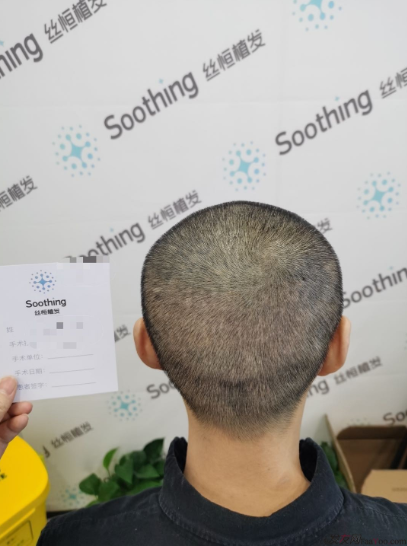 發(fā)友網(wǎng)與機(jī)構(gòu)活動(dòng)植發(fā)，前后效果對比、記錄