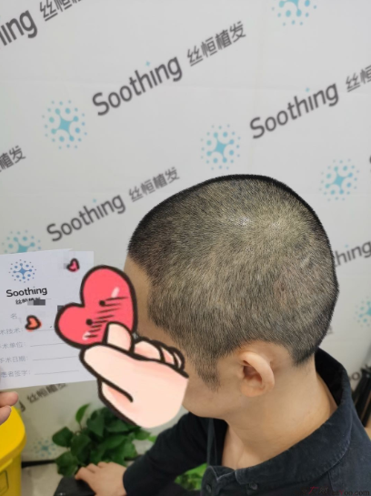 發(fā)友網(wǎng)與機(jī)構(gòu)活動(dòng)植發(fā)，前后效果對比、記錄