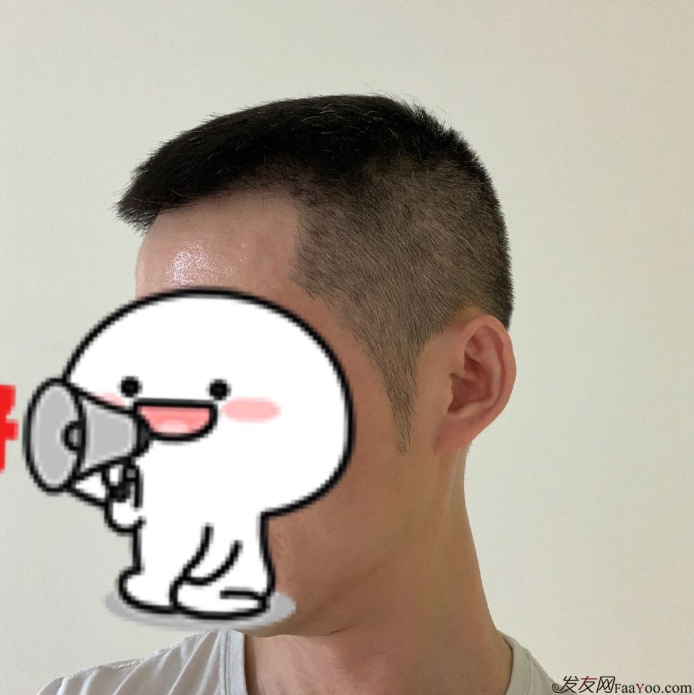 發(fā)友網(wǎng)與機(jī)構(gòu)活動(dòng)植發(fā)，前后效果對比、記錄