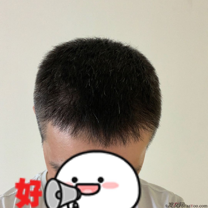 發(fā)友網(wǎng)與機(jī)構(gòu)活動(dòng)植發(fā)，前后效果對比、記錄