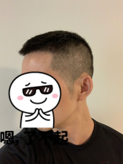 發(fā)友網(wǎng)與機(jī)構(gòu)活動(dòng)植發(fā)，前后效果對比、記錄