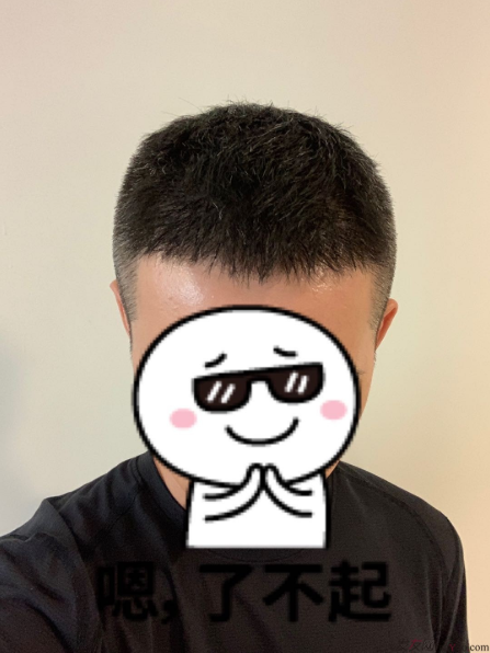 發(fā)友網(wǎng)與機(jī)構(gòu)活動(dòng)植發(fā)，前后效果對比、記錄