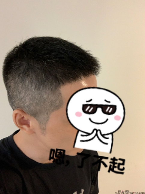 發(fā)友網(wǎng)與機(jī)構(gòu)活動(dòng)植發(fā)，前后效果對比、記錄