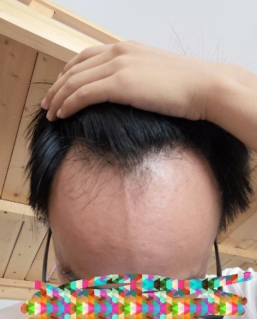 南昌科發(fā)源植發(fā)（現(xiàn)大麥微針），看看大額頭怎么蛻變的