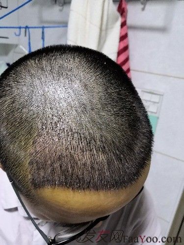 南昌科發(fā)源植發(fā)（現(xiàn)大麥微針），看看大額頭怎么蛻變的