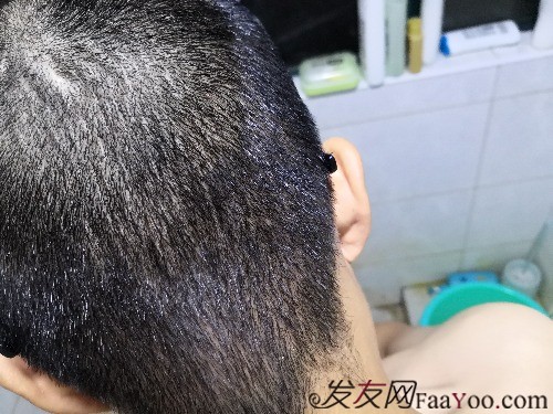 南昌科發(fā)源植發(fā)（現(xiàn)大麥微針），看看大額頭怎么蛻變的