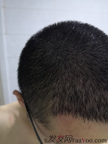 南昌科發(fā)源植發(fā)（現(xiàn)大麥微針），看看大額頭怎么蛻變的