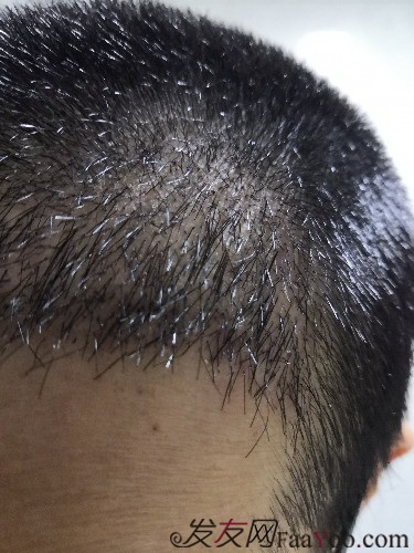 南昌科發(fā)源植發(fā)（現(xiàn)大麥微針），看看大額頭怎么蛻變的