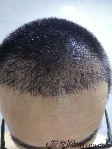 南昌科發(fā)源植發(fā)（現(xiàn)大麥微針），看看大額頭怎么蛻變的